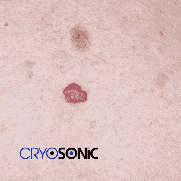 Looking for pain free cherry angioma removal treatment Bletchley? Call our team today! Bletchley