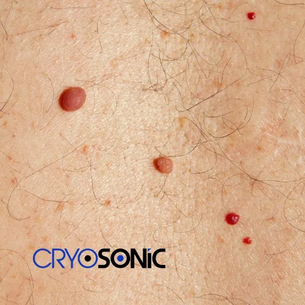 get cherry angioma removal treatment today! Bletchley