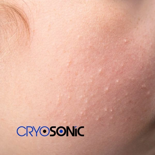 Are you looking for milia removal treatment? Contact our team today Bletchley