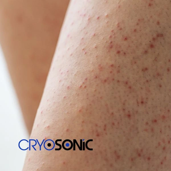 Looking for Seborrhoeic Keratosis removal Bletchley treatment? Call our consultants today in Bletchley