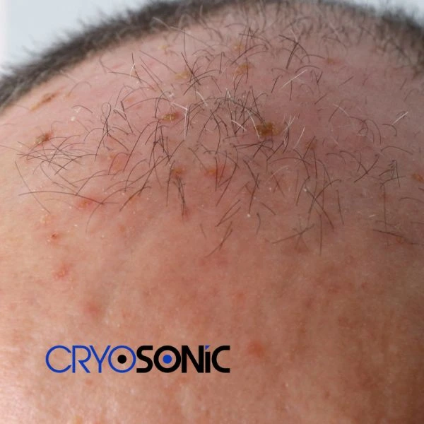 Access Seborrhoeic Keratosis removal from the comfort of your own home! Call us today in Bletchley