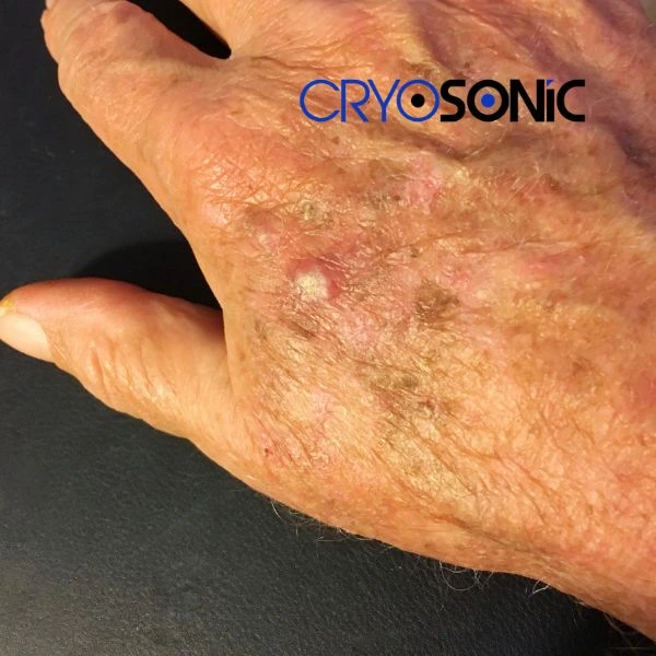 Understand more about actinic keratosis treatment today Bletchley
