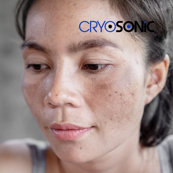 Ready to start age spots removal? Contact our team today in Bletchley