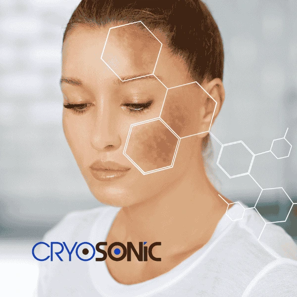 Are you looking for age spot removal treatment? Contact Cryosonic today in Bletchley