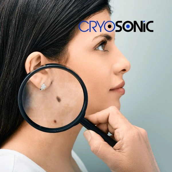 Do you want to learn more about benign moles removal treatment? Call our team today Bletchley