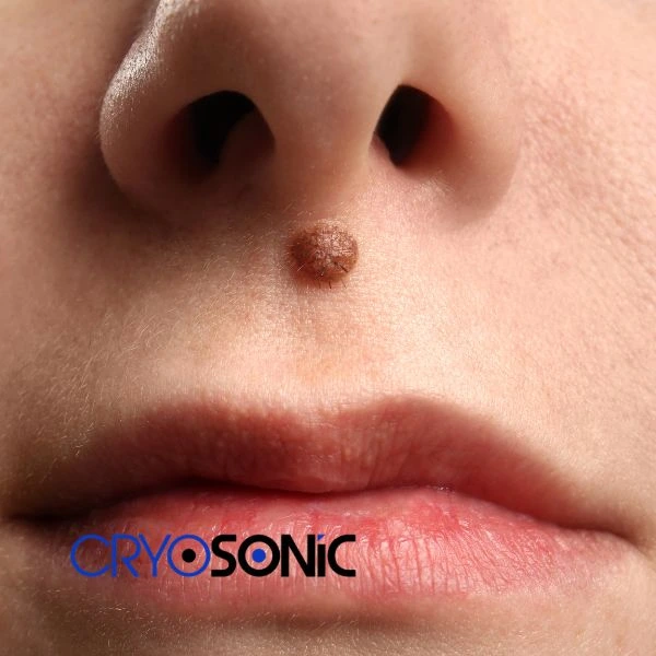 Start your benign moles removal treatment today Bletchley