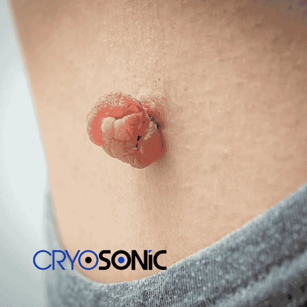 Book your skin tags removal Bletchley from comfort of your own home! Bletchley
