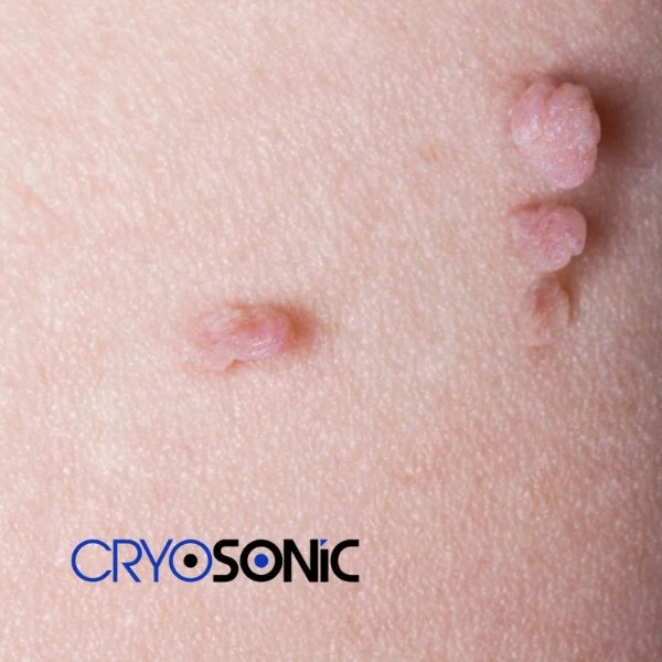 Are you looking for fast effect skin tag removal Bletchley? Book in NOW! Bletchley