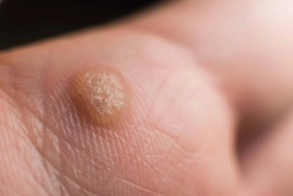 CryoPen treatment for Common Warts showing precise freezing of viral skin lesions for safe and effective removal Bletchley