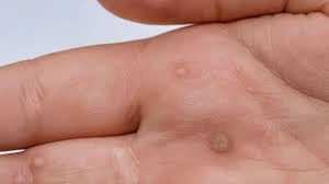 CryoPen treatment results showing smooth skin after Common Warts Bletchley removal with reduced risk of recurrence Bletchley