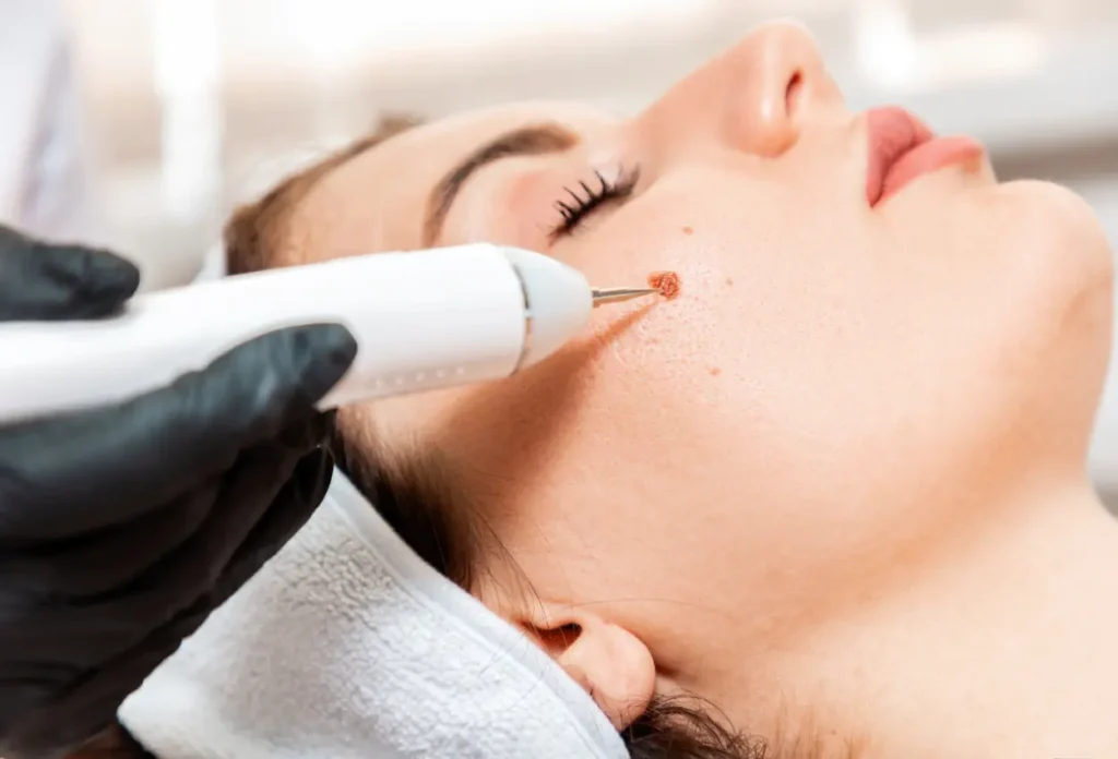 CryoPen Accuracy Bletchley being used to safely and precisely remove multiple skin lesions, illustrating answers to common patient FAQs Bletchley
