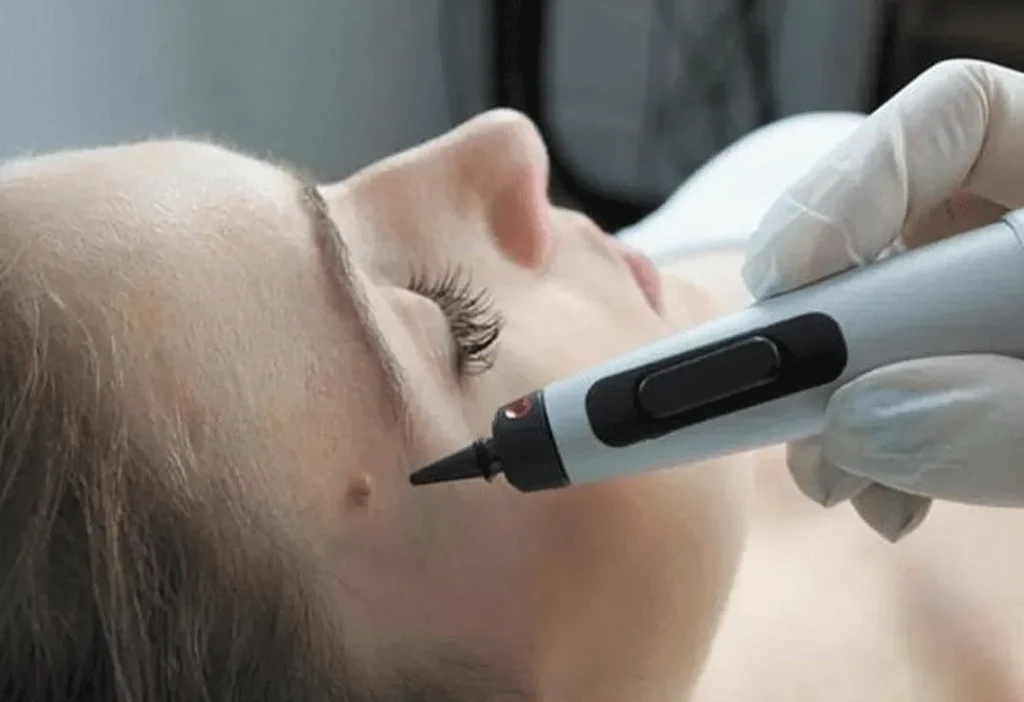 CryoPen accurately targeting skin lesions with millimetre-precision for safe and effective removal by Cryosonic Bletchley