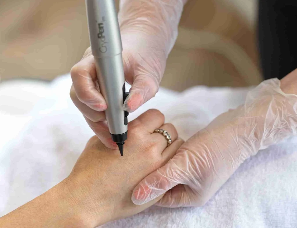 CryoPen Accuracy Bletchley in action, precisely targeting a skin lesion to ensure safe treatment and protect surrounding healthy skin Bletchley
