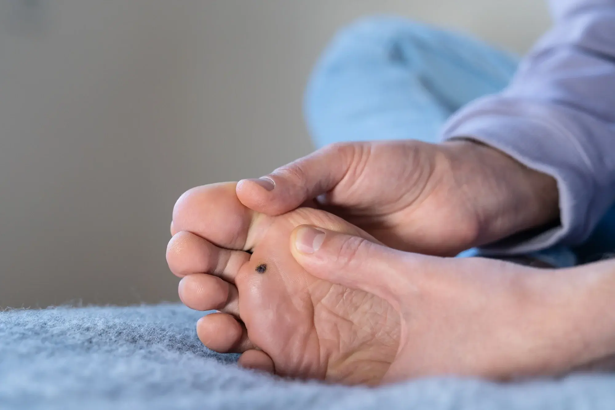 CryoPen treatment for multiple and stubborn Plantar Warts (Verrucae) Bletchley, showing safe, precise removal and patient-friendly procedure Bletchley