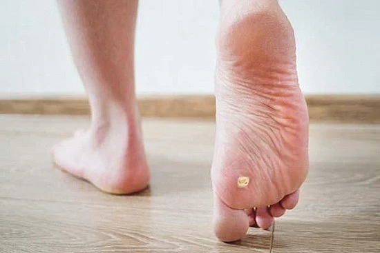 CryoPen treatment removing stubborn Plantar Warts (Verrucae) for precise, safe, and effective relief from resistant lesions Bletchley