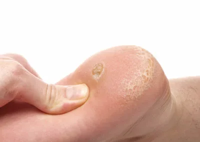 Painful Plantar Warts (Verrucae) Bletchley, highlighting how stubborn warts affect everyday activities and comfort Bletchley