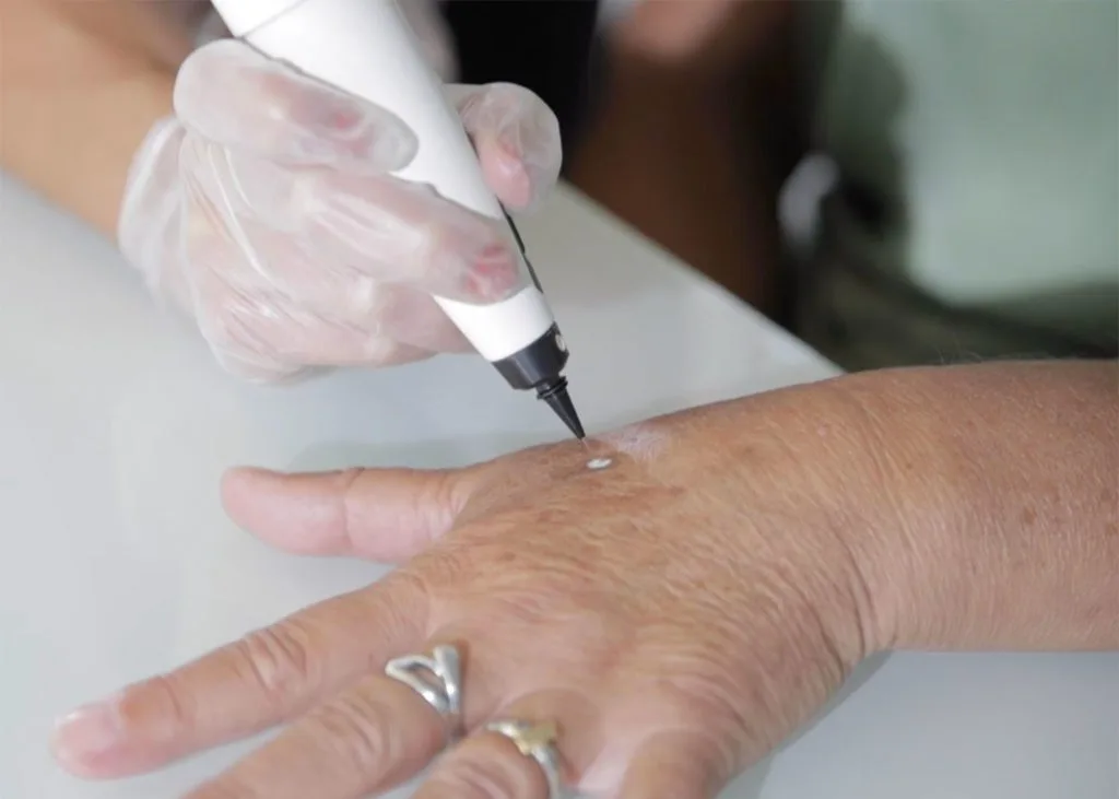 Close-up of CryoPen accuracy Bletchley targeting a skin lesion, showing why precision matters for safe and effective removal Bletchley