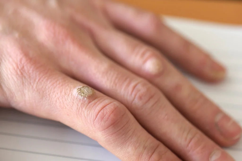 Patient considering removal of Common Warts Bletchley for cosmetic improvement, comfort, and hygiene with CryoPen treatment Bletchley