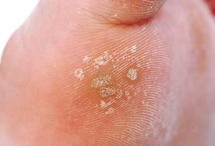 Close-up of Common Warts Bletchley on skin, showing small rough viral lesions typically caused by HPV infection Bletchley